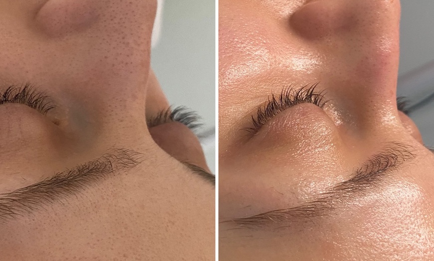 Image 10: Microneedling-Behandlung oder Enzym-Lifting-Paket für 1 Person