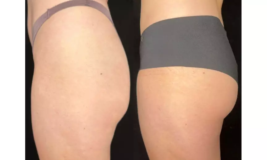 Tone with Five Sessions of Body Sculpting - Small or Large Area