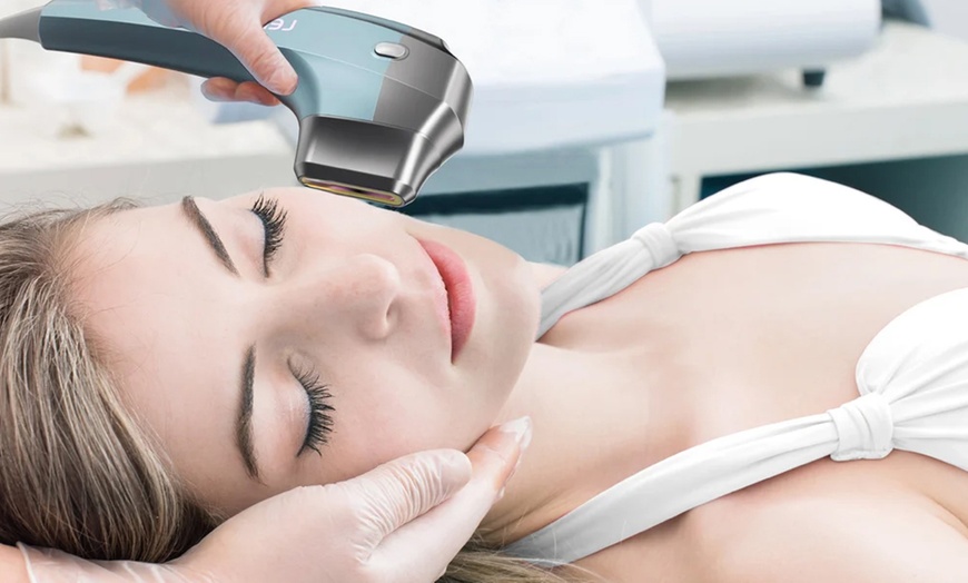 Image 2: Tratamiento HIFU 12D Ultra-lifting con radiofrecuencia 