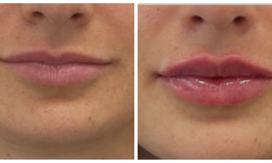 Image 5: Juvederm Lip Filler Injections for Enhanced Natural Beauty 