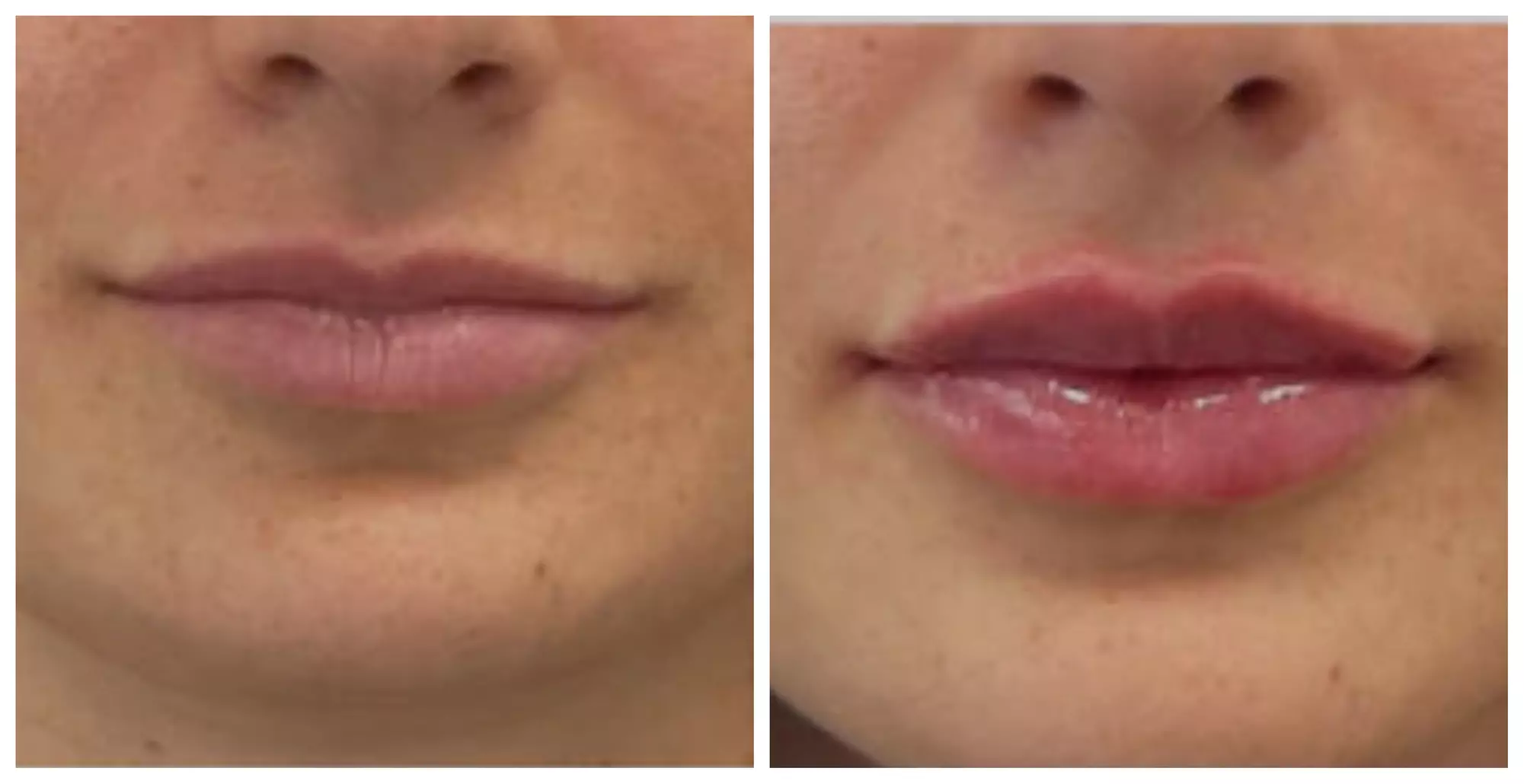 Juvederm Lip Filler Injections for Enhanced Natural Beauty