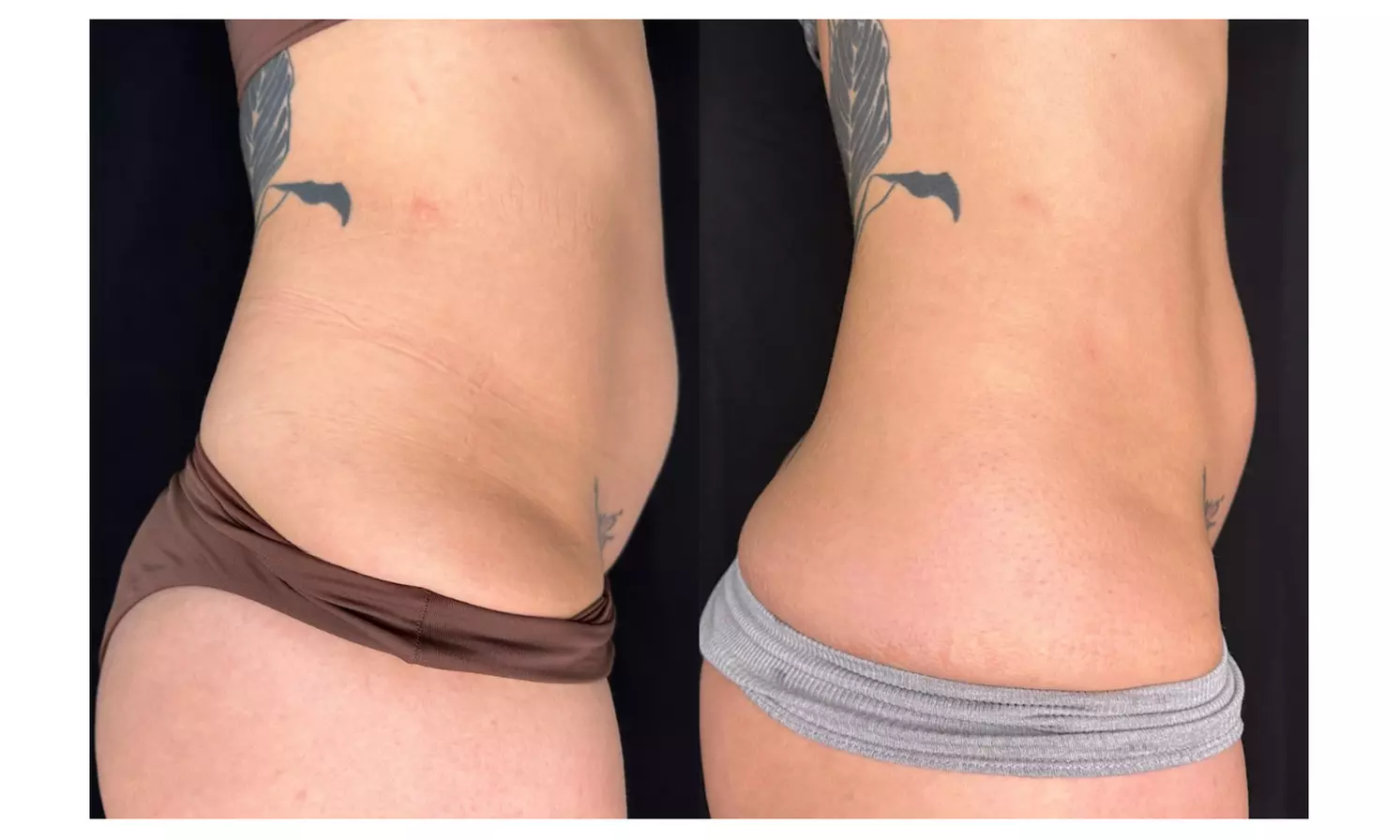 Tone with Five Sessions of Body Sculpting - Small or Large Area