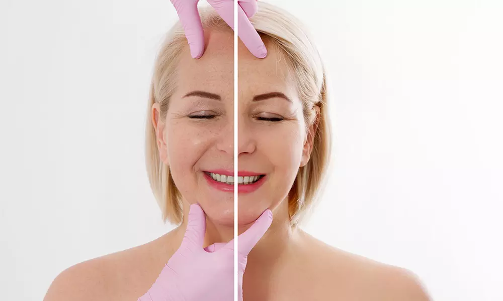 50, 100, or 150 Units of Dysport w/ Optional 1ML Syringe of Restylane