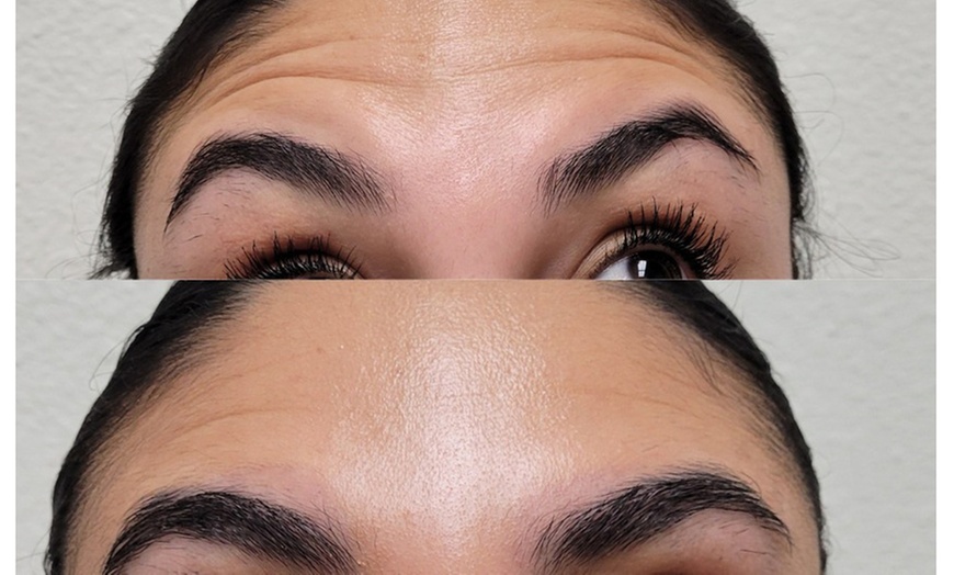 Image 2: Glow Your Skin w/ 1 Vial of Sculptra or 1 Syringe of Restylane Lyft