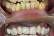 Up to 30% Off on Teeth Whitening at Grin & Glow - Second Medium