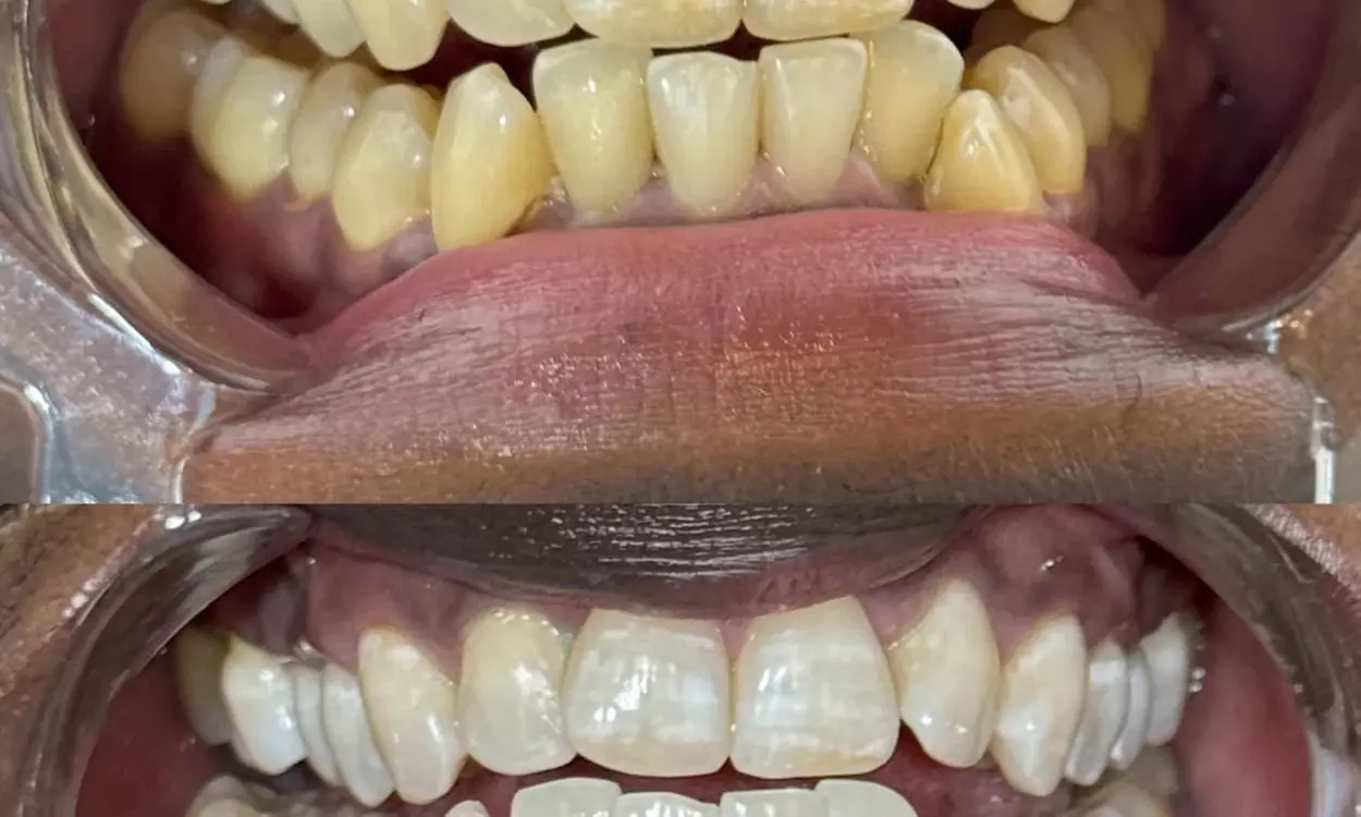 Teeth Whitening Sessions in 30–90 Min or Couples 60–90 Min Options