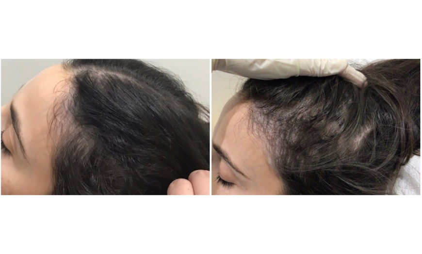 Image 2: One, Two, or Three Sessions of  PRP Hair Growth Treatment 