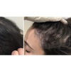 Image 2: One, Two, or Three Sessions of  PRP Hair Growth Treatment 
