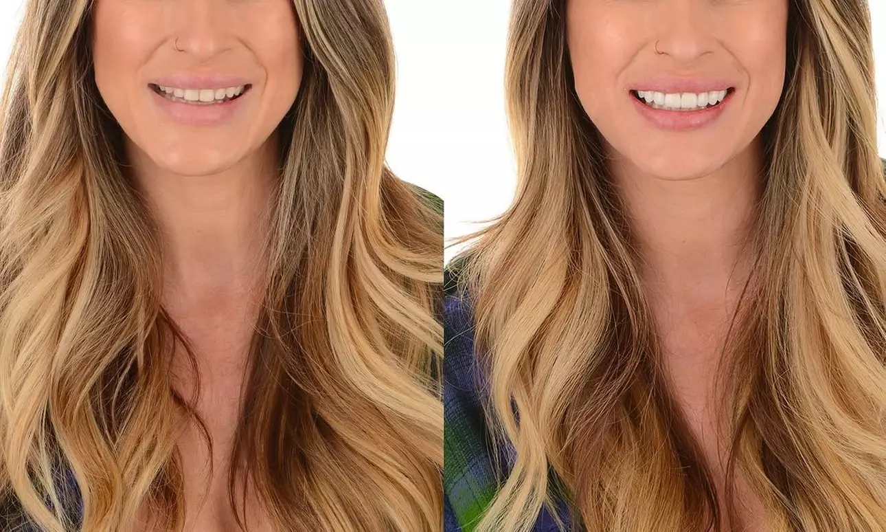 Colocación de hasta 4 carillas dentales de composite o cerámica