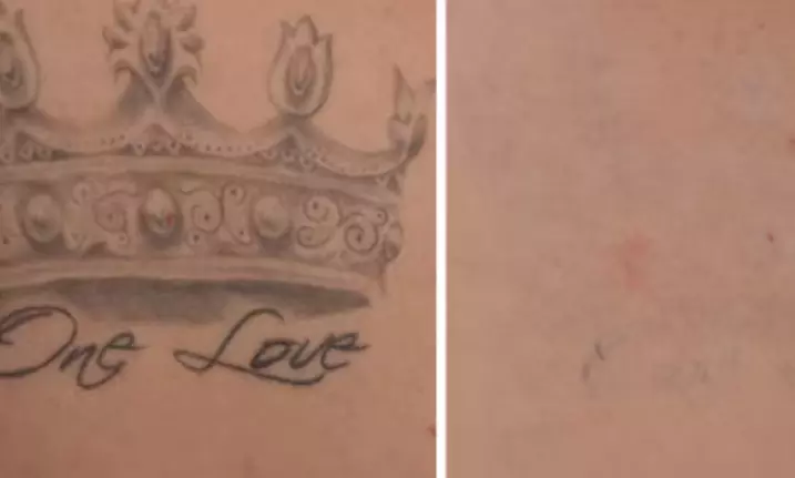 One Laser Tattoo Removal Session on a Small, Medium, or a Large Area