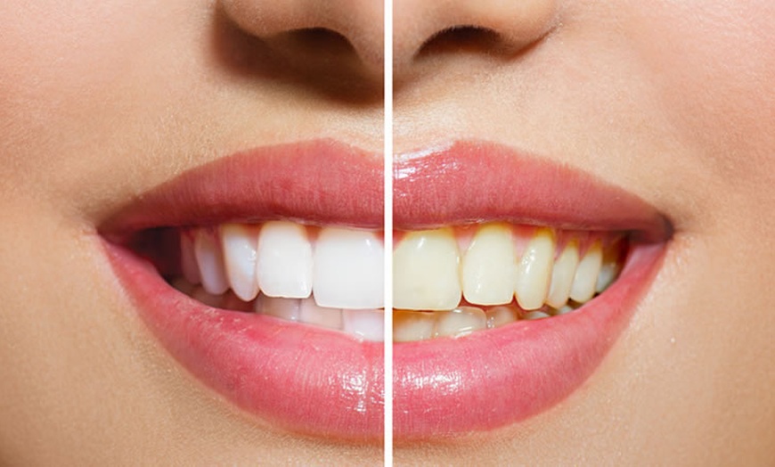 Image 1: One 60-Minute Premium Teeth Whitening at Skinnovate Clinic