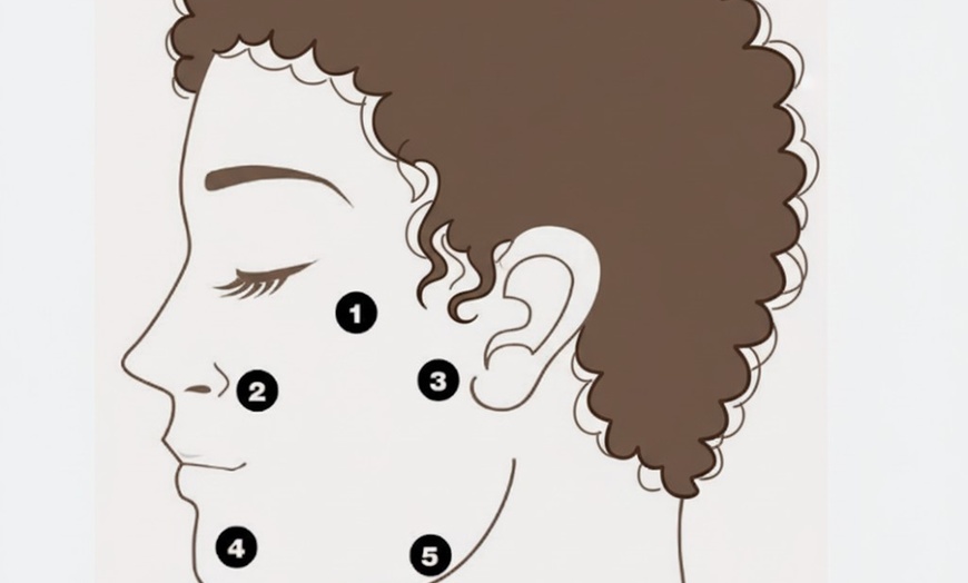 Image 6: 10- oder 16 Punkte Hyaluron-Lifting mit innovativer BAP-Technik