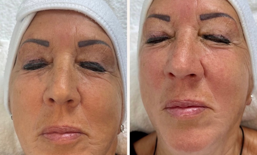 Image 6: Hydrafacial Glow & Lashlifting bij Beauty Clinic by Nouha