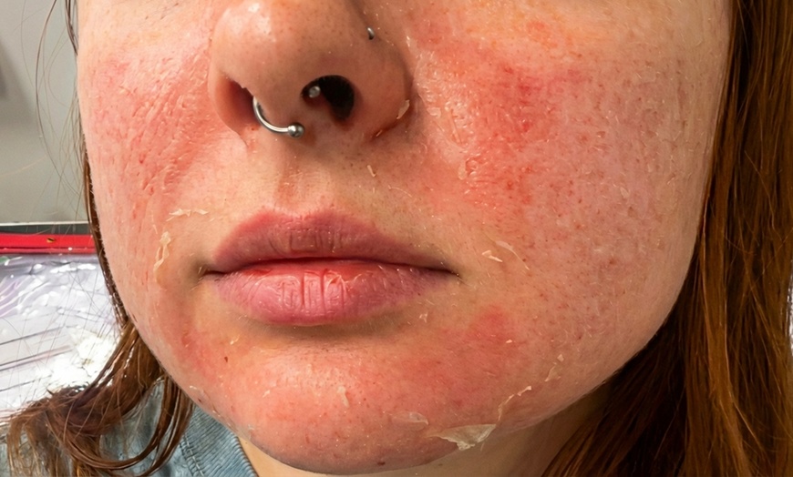 Image 5: One, Two, Three or Four Professional Grade Pro Chemical Peels