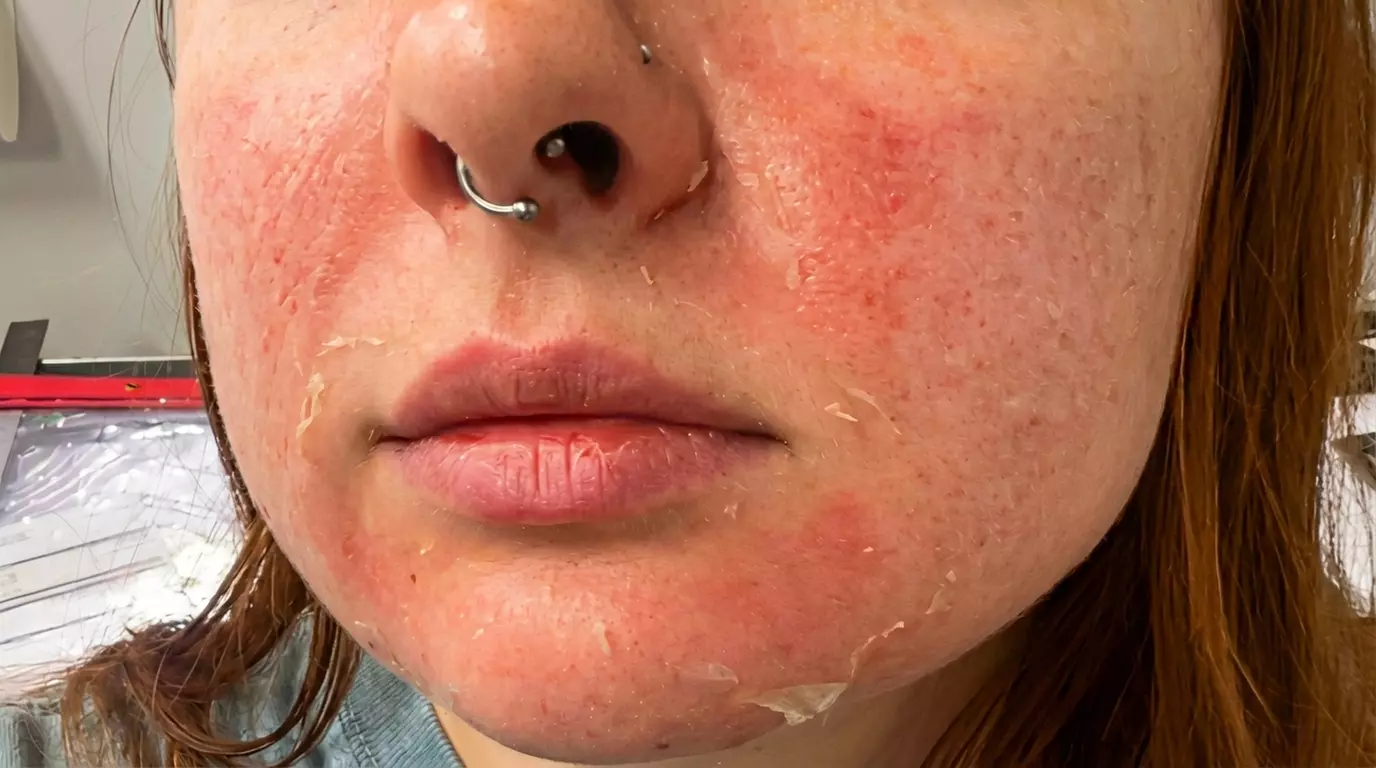 One, Two, Three or Four Professional Grade Pro Chemical Peels