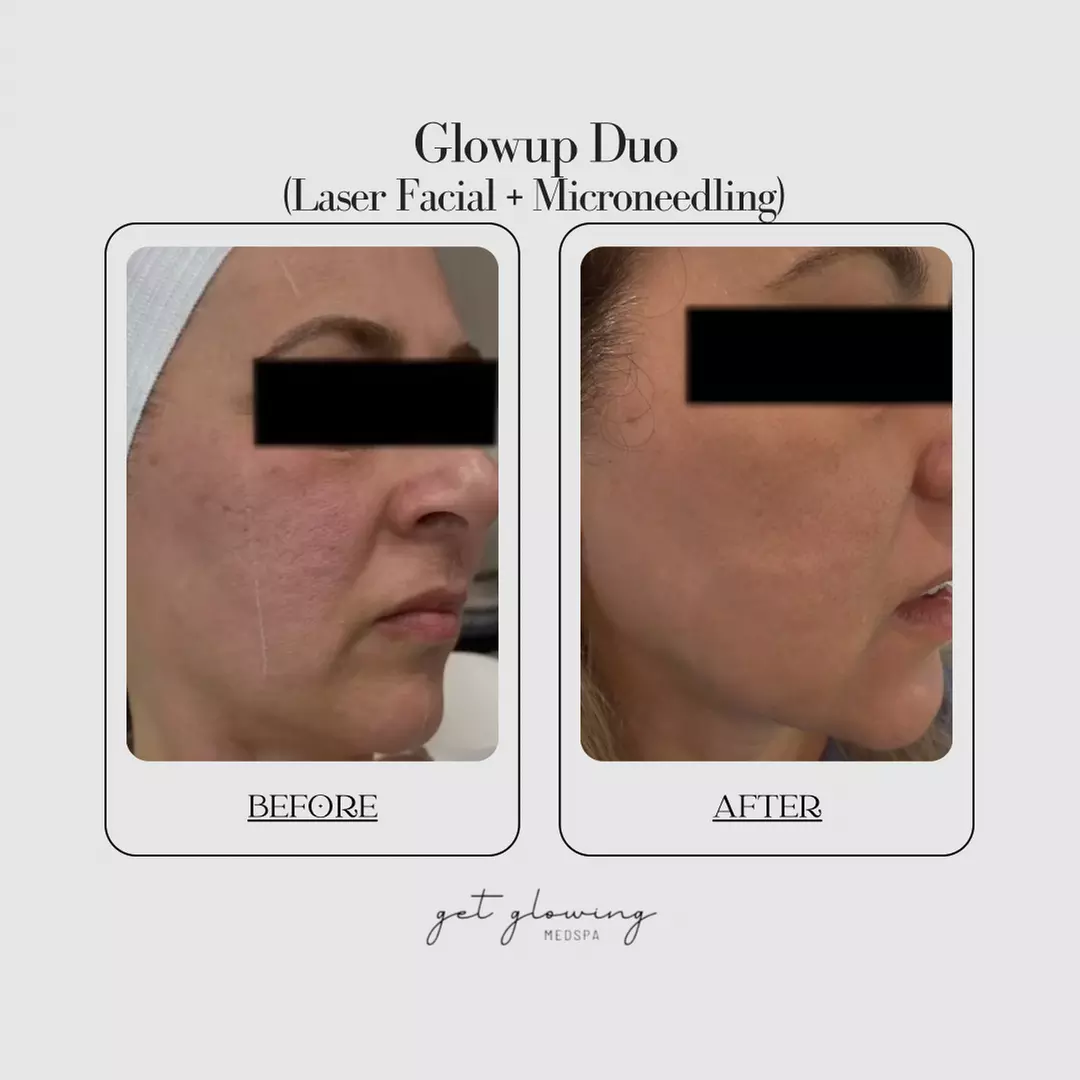 Up to 65% Off on Micro-Needling with PRP at Get Glowing Medspa  - Second Medium