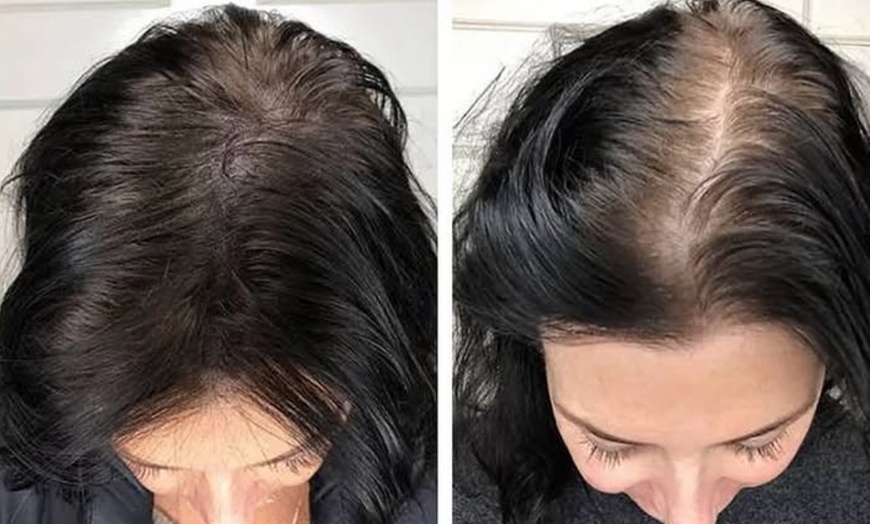 Image 1: Restore Confidence with Scalp Micropigmentation at Rose Beauty Bar