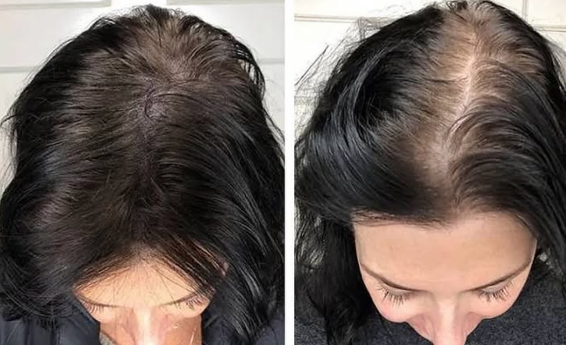 Restore Confidence with Scalp Micropigmentation at Rose Beauty Bar