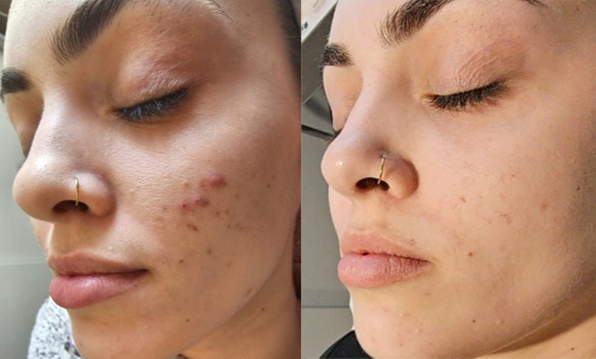 Image 5: 1 or 3 Sessions: Skin Needling + Facial Sheet Mask + LED Light Therapy