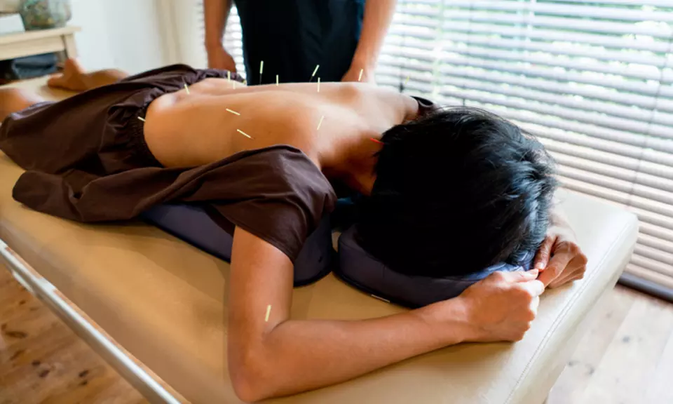Acupuncture Treatment or Acupuncture & Tui Na Massage up to 60 minutes – Save Up to 51% - Primary Image