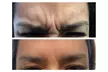 Rejuvenate Your Appearance with Sona Med Spa's  20 Units of Botox Treatment (Up to 37% Off) - Second Medium