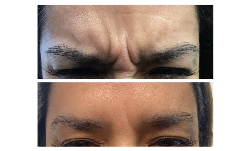 Image 3: Revitalize Your Appearance with 20 Units of Botox Treatment