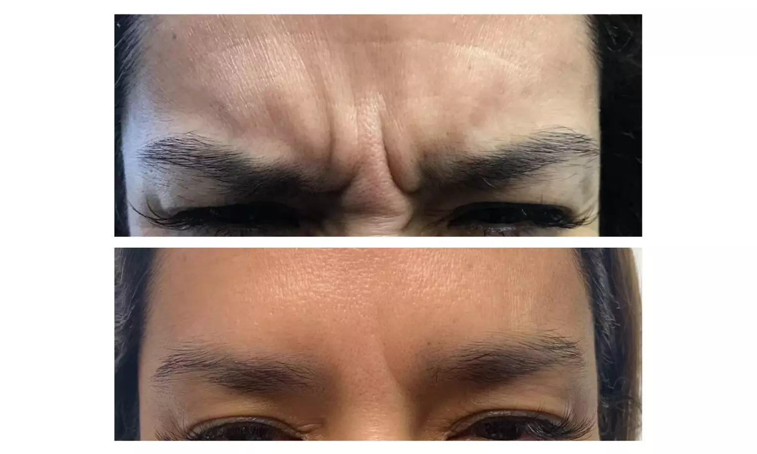 Revitalize Your Appearance with 20 Units of Botox Treatment