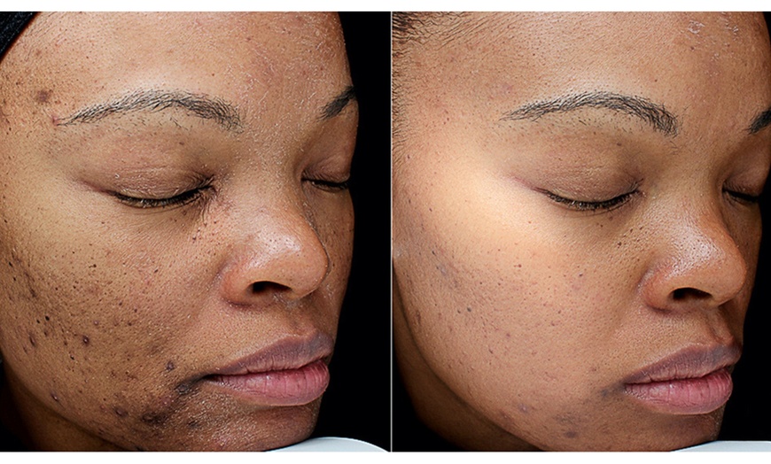 Image 3: VI Original, Purify or Advanced Peel with LED Light Therapy