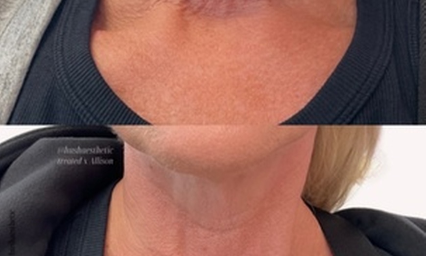 Image 5: Revitalize Your Look with 20 Units of Botox