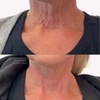 Image 5: Revitalize Your Look with 20 Units of Botox