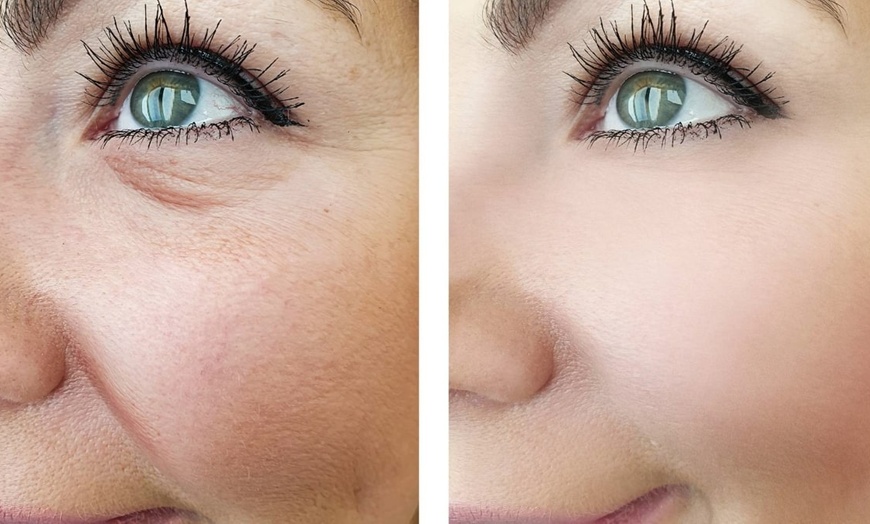 Image 5: Microneedling for Face & Neck or BB Glow Facial with Microneedling