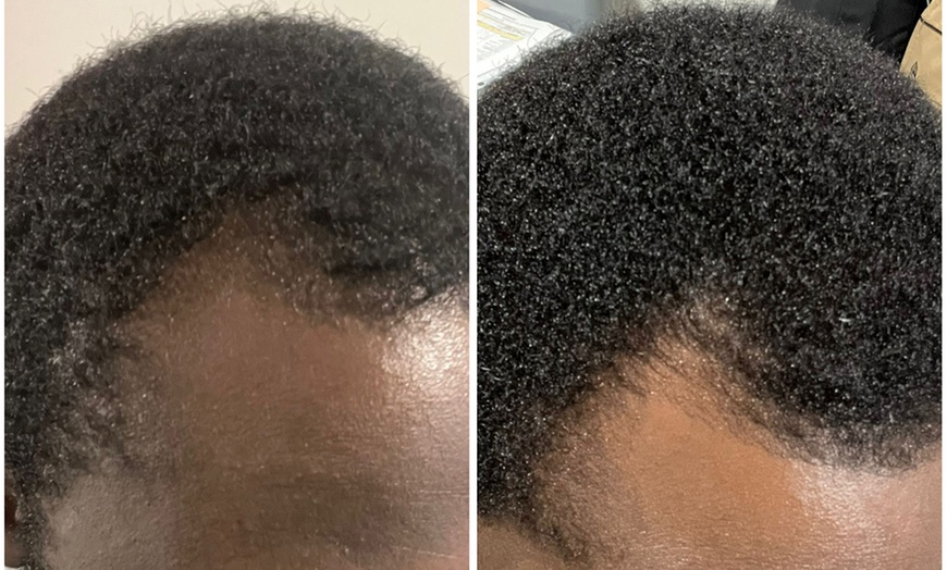 Image 3: Facial Revitalization With PRP Facial or PRP Hair Restoration