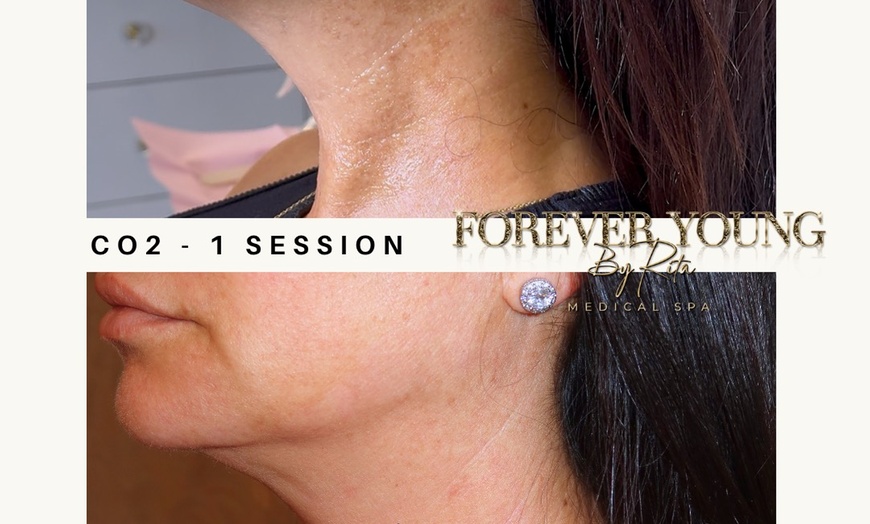 Image 5: Light or Intense Mode CO2 Laser Resurfacing Treatment for Full Face