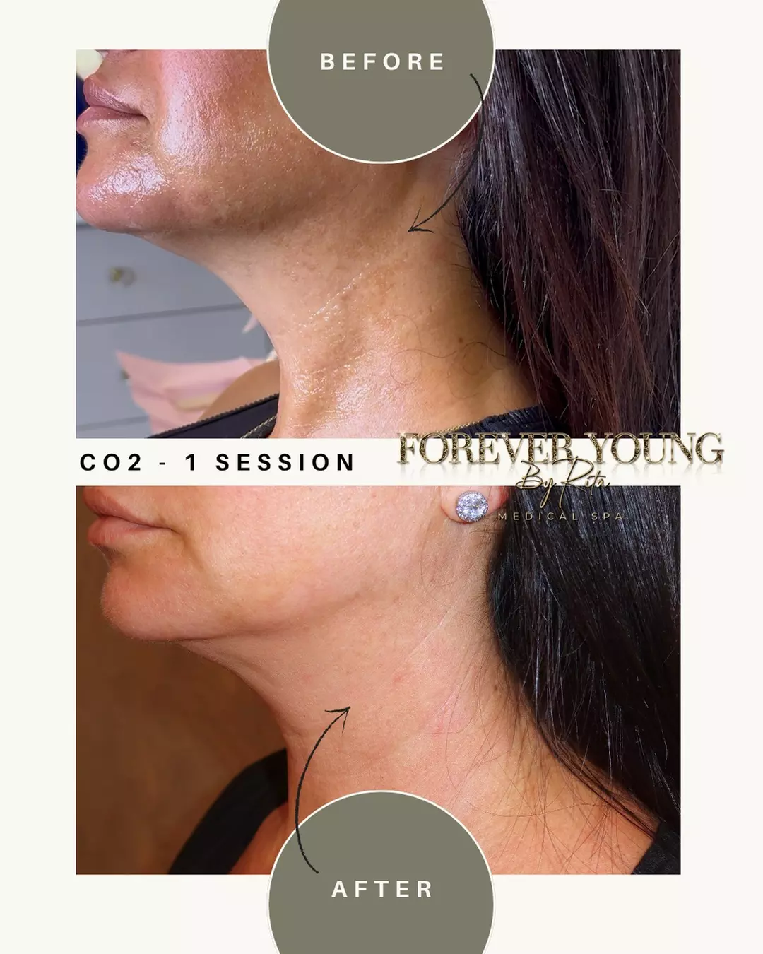 One Light or Intense Mode CO2 Laser Resurfacing Treatment for Full Face at Forever Young by Rita (Up to 55% Off)