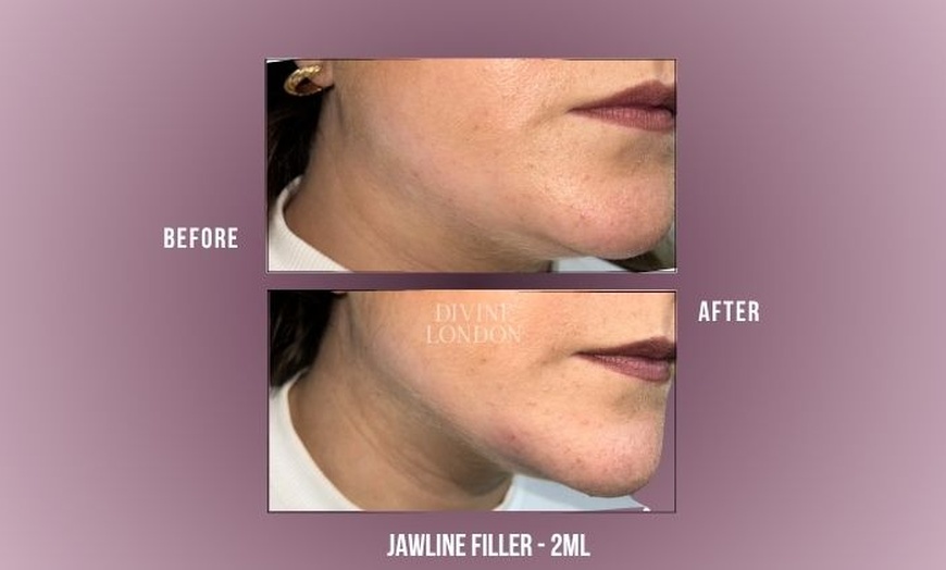 Image 4: Up to 71% Off on Injection - Dermal Filler at Divine Aesthetics Clinic London