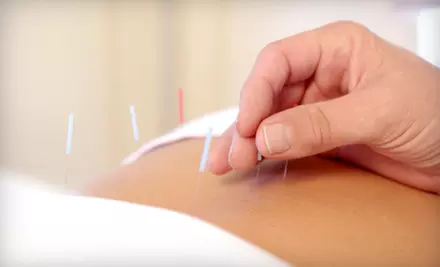 One or Three Acupuncture Sessions with Tuina Massage at Ontario College of Traditional Chinese Medicine (Up to 76% Off) - Primary Image