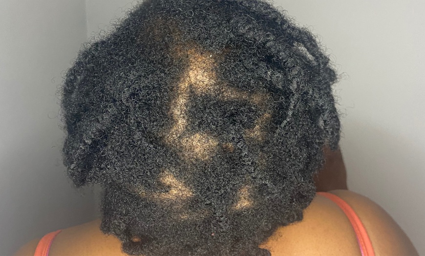 Image 3: Scalp Analysis and Hair Restoration Consultations
