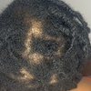 Image 3: Scalp Analysis and Hair Restoration Consultations