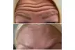 Lip Flip or 20–40 Xeomin Units for Smoother Skin & Fuller Lips at Slim Fit Beauty Up To  59% Off - Second Medium