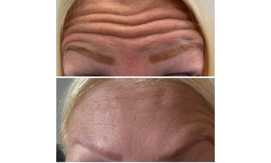 Image 7: Lip Flip or 20–40 Units of Xeomin for a Smooth, Youthful Look 