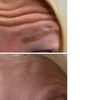 Image 7: Lip Flip or 20–40 Units of Xeomin for a Smooth, Youthful Look 