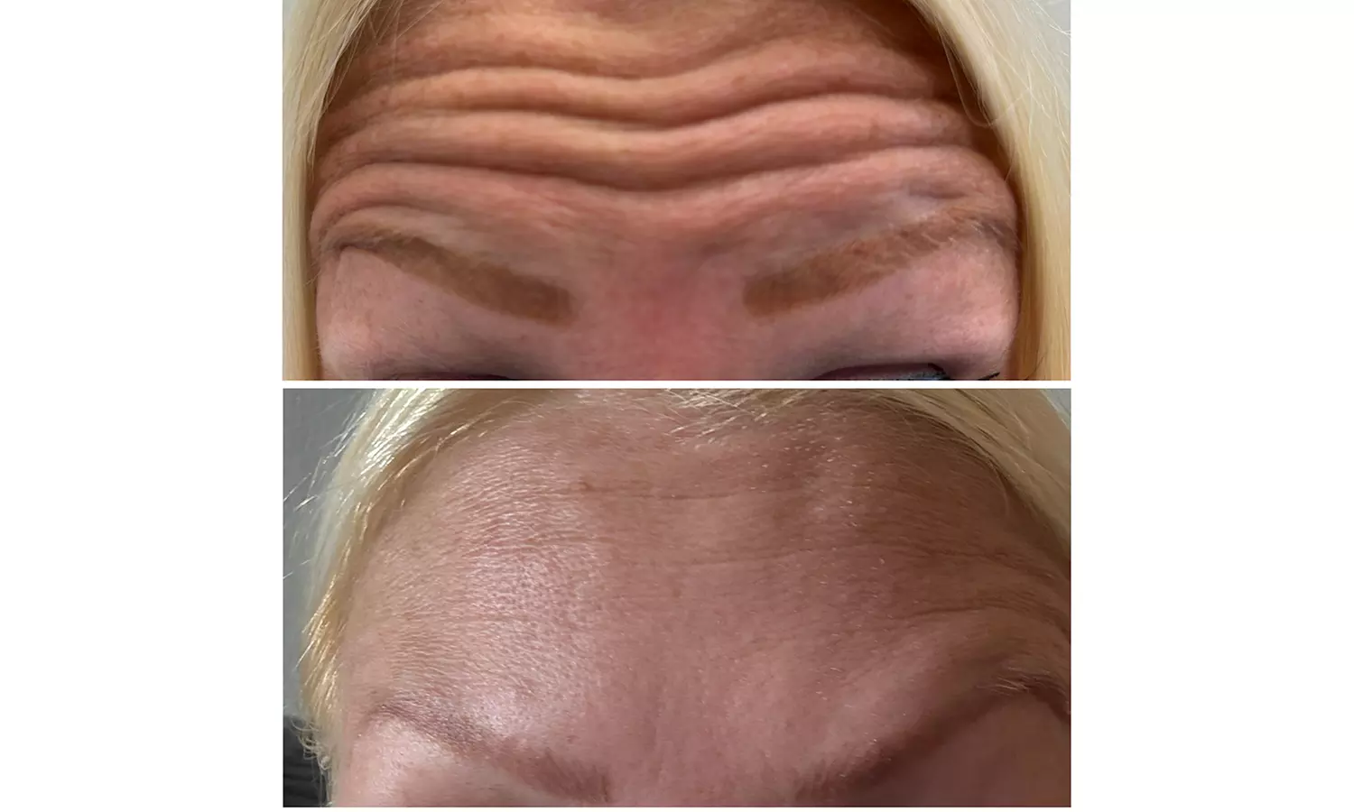 Lip Flip or 20–40 Units of Xeomin for a Smooth, Youthful Look