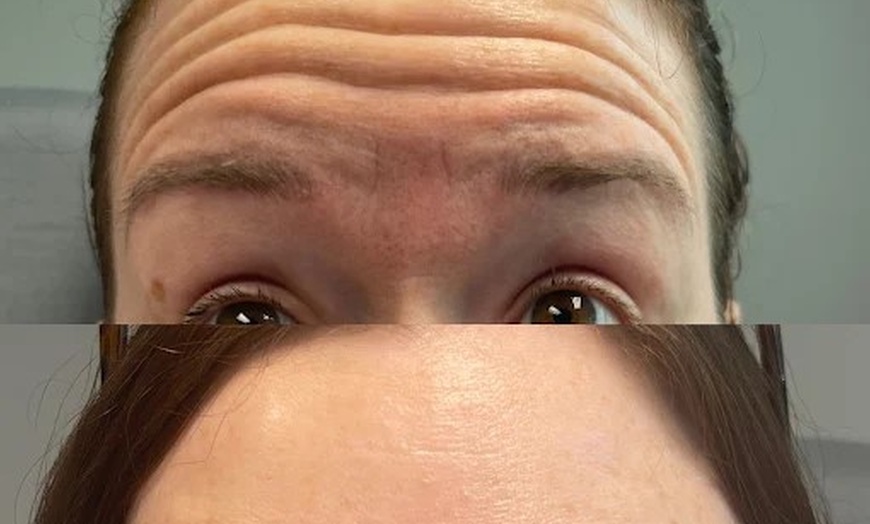 Image 2: Youthful Glow with 20, 30, 40, 60, or 100 Units of Botox Injections