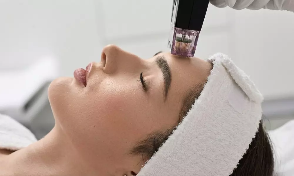 One, Three, or Five Sessions of 60-Minutes Micro-Needling Treatment