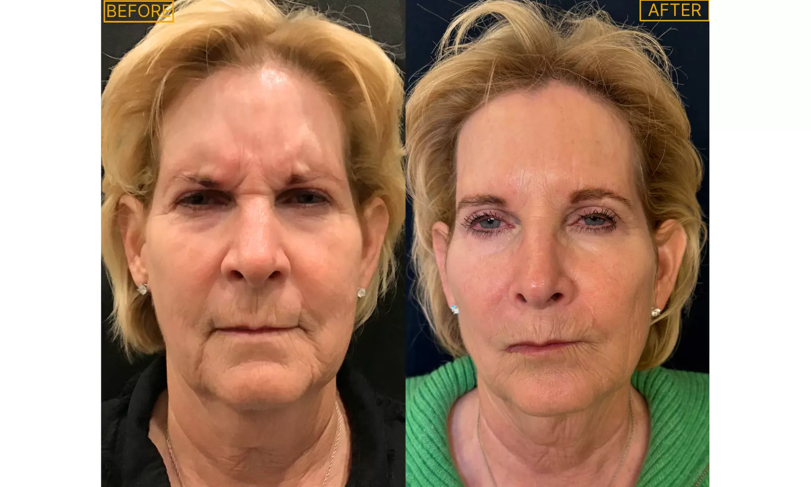 Get a Smoother Look with Botox for Frown Lines or Crows Feet