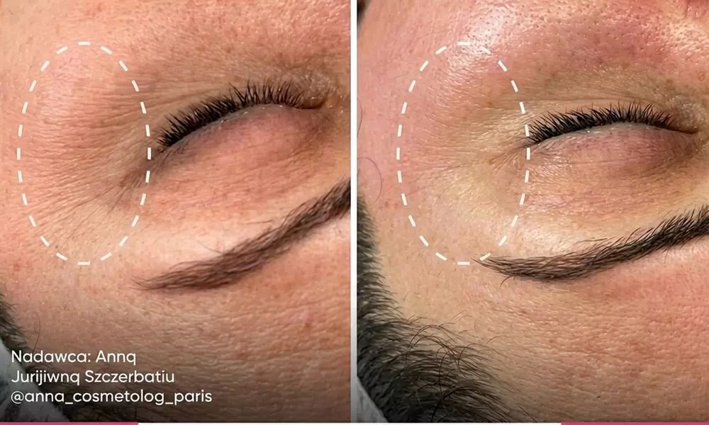 Niechirurgiczny lifting RF