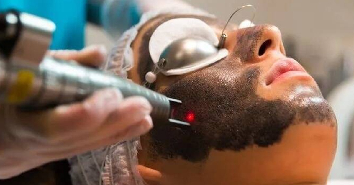 Tratamiento facial Hollywood peeling con carbón activo y láser en Madrid