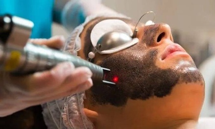 1 sesion: Hollywood peeling con mascarilla de carbón activo y láser - Supreme Beauty Center