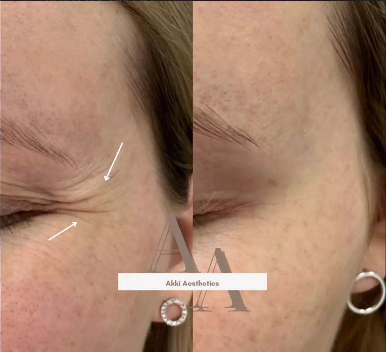 Enhance Your Look with 20, 40, or 60 Units of Botox