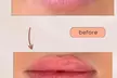 Achieve Fuller Lips with 0.5ml or 1ml - Lip Filler at Glovia ( Up to 47% Off ) - Image 5